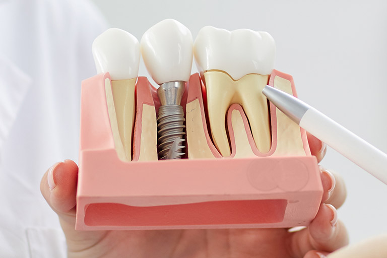 Implantes dentales en Piedras Blancas