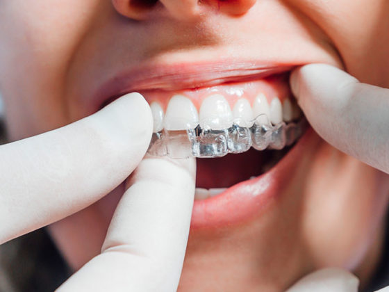 Ortodoncia como parte de un cambio de imagen. Clínica Dental Zapico, ortodoncia en Piedras Blancas