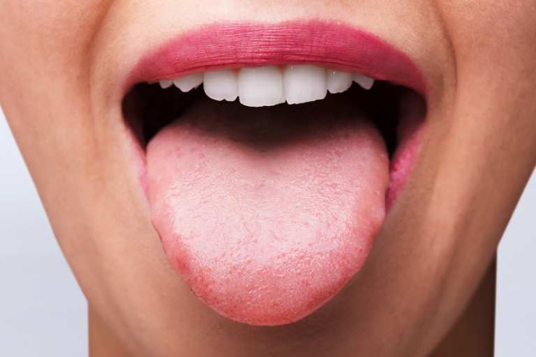 ¿Cómo tratar las quemaduras de la lengua