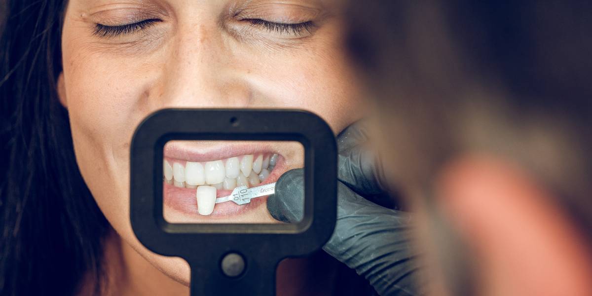 Realizando una toma de color durante un tratamiento de carillas dentales.