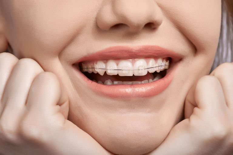 Mujer con brackets sonriendo - Impacto de los Brackets en las Encías - Clínica Dental Zapico - Ortodoncia Piedras Blancas